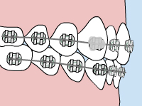 loose bracket - Emergency Care