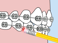 poking wire - Emergency Care